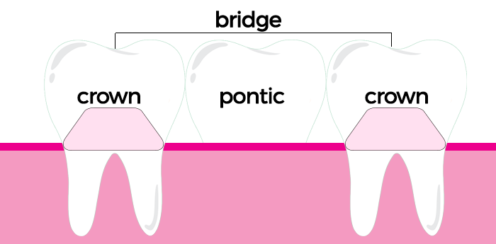 dental implants Tucson