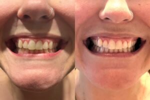 Teeth Whitening Kor